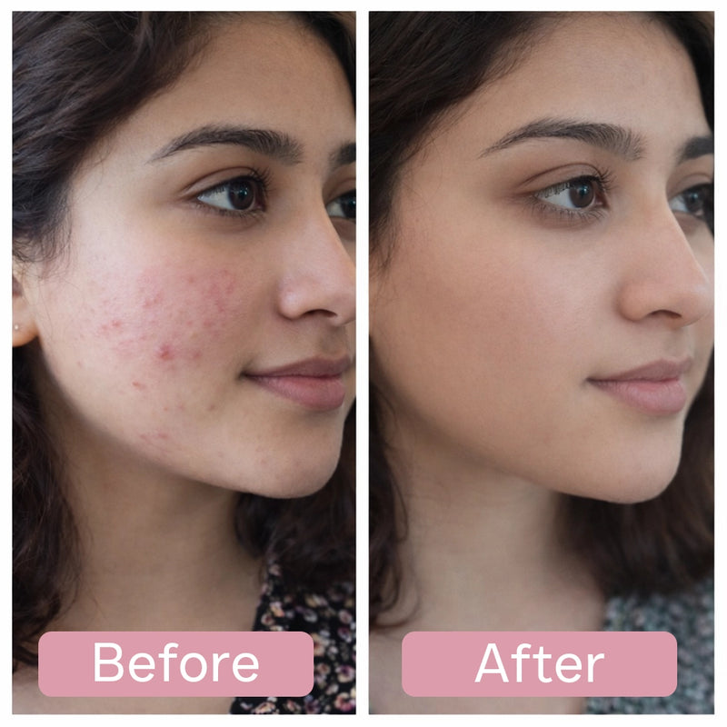 Before and after comparison of a person's face with visible acne on the left and clear skin on the right.