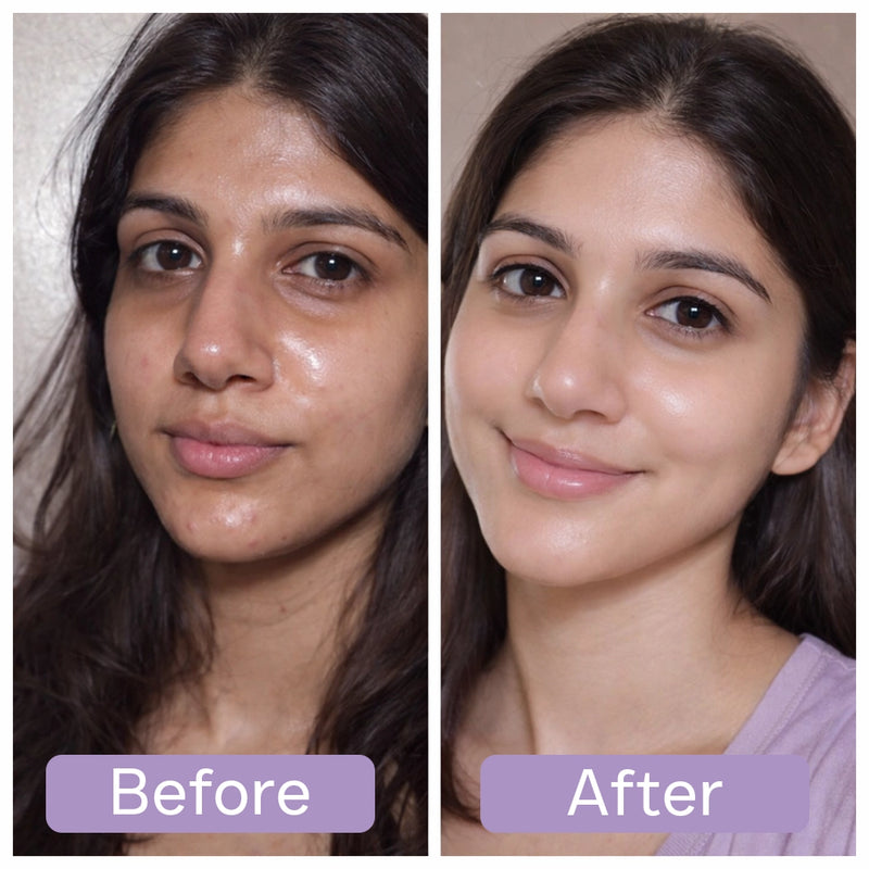 Before and after comparison of a woman's face with visible skin treatment.